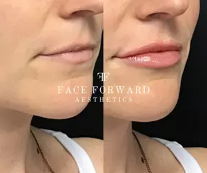 Up to 29% Off Botox and Juvéderm at Face Forward Aesthetics