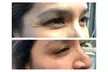 Revitalize Your Look with 20 Units of Botox at Sona MedSpa of Richmond - Glen Allen (Up to 30% Off) - Second Medium