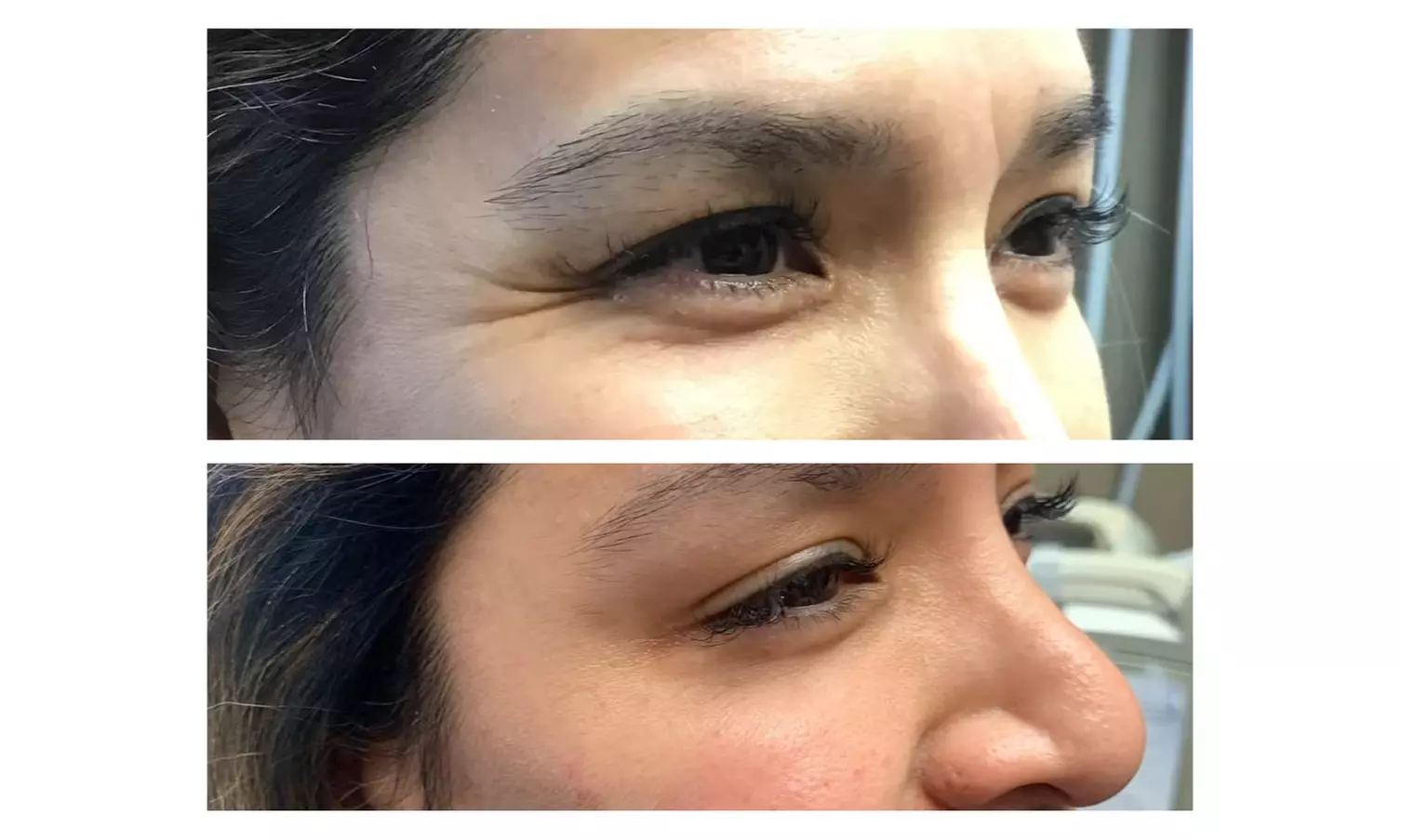 Revitalize Your Look with 20 Units of Botox