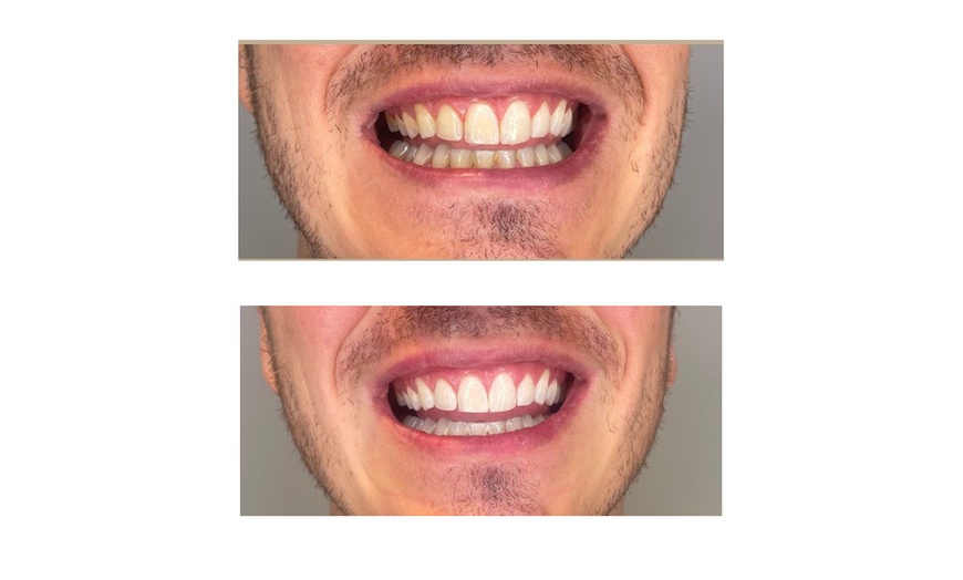 Image 13: Teeth Whitening - In-Office - Non-Branded at Splendida