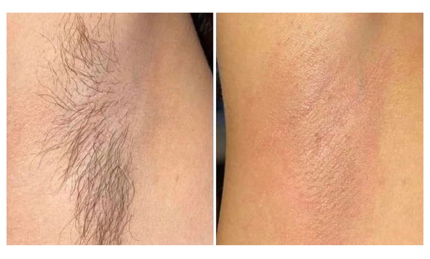 Image 3: Peau douce, esprit libre : 3 séances d’épilation laser sur mesure