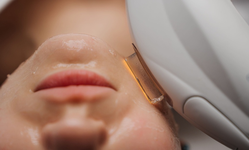 Image 11: 1 o 3 sesiones de tratamiento láser para manchas y acné