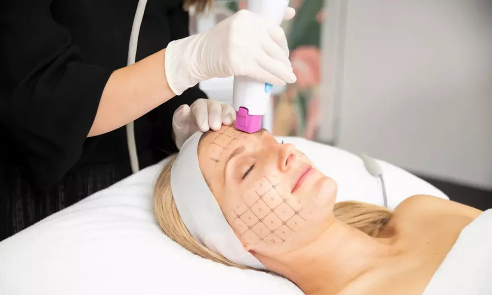 1 o 3 sesiones de tratamiento rejuvenecedor con radiofrecuencia