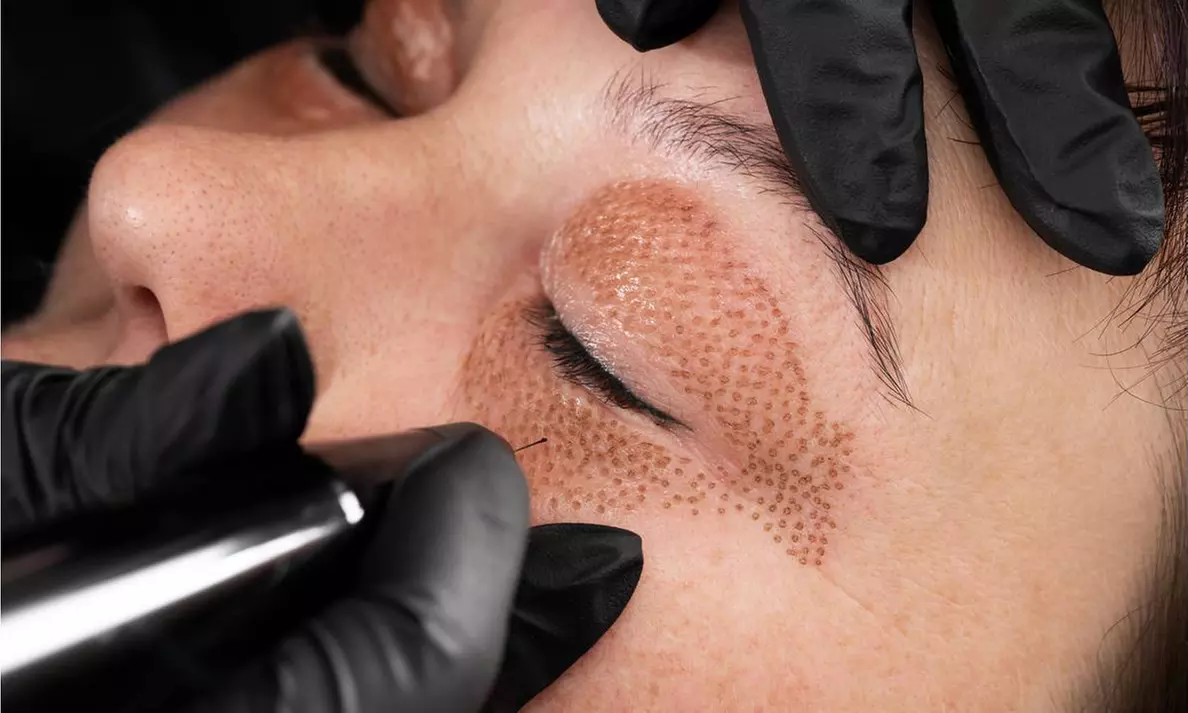 Fibroblast Plasma Treatment at Doors To Heaven Spa (Up to 57% Off). Three Options Available. - Primary Image