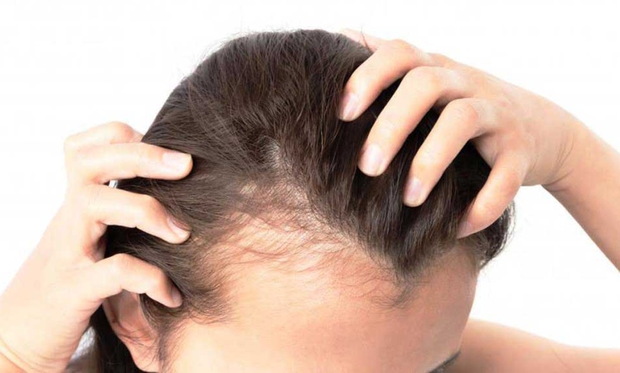 Image 1: Choice of One, Three or Six Sessions of Korean Hair Growth Treatment