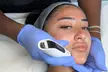 Perfection Clinic: 1 or 3 Advanced Micro-needling w/ Luxury Hydrating Serums - Face and/or Neck (Up to 64% Off) - Second Medium