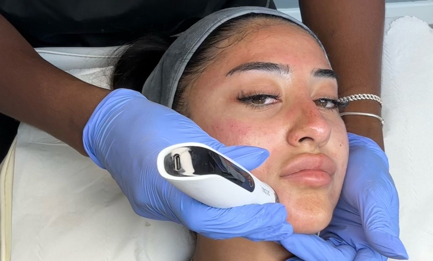 Image 7: Advanced Micro-needling w/ Luxury Hydrating Serums - Face and/or Neck