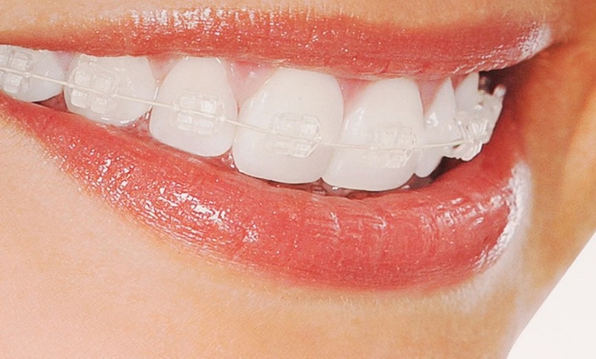 Image 1: Orthodontic Braces at VidaDent
