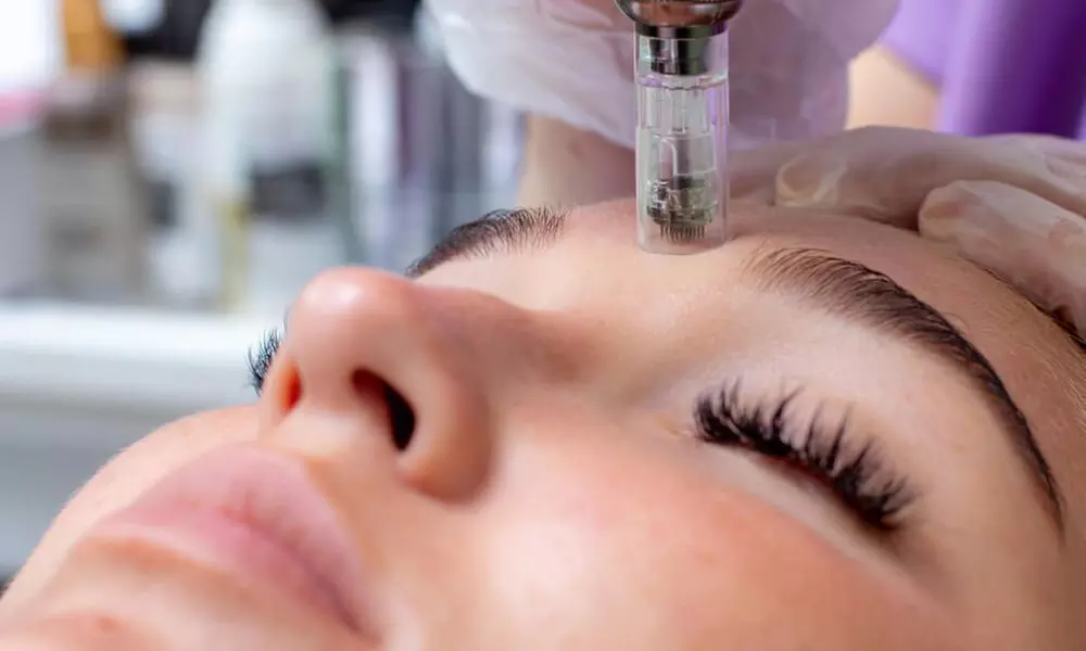 Enhance Skin with Micro-Needling Using Collagen or PRP