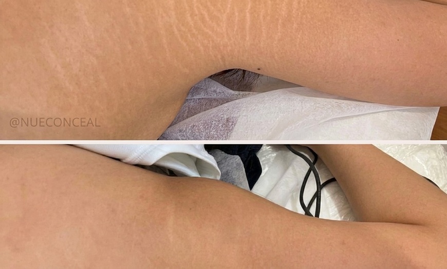 Image 3: Stretch Mark or Scar Treatment - Inkless or Camouflage(Mon-Sat)