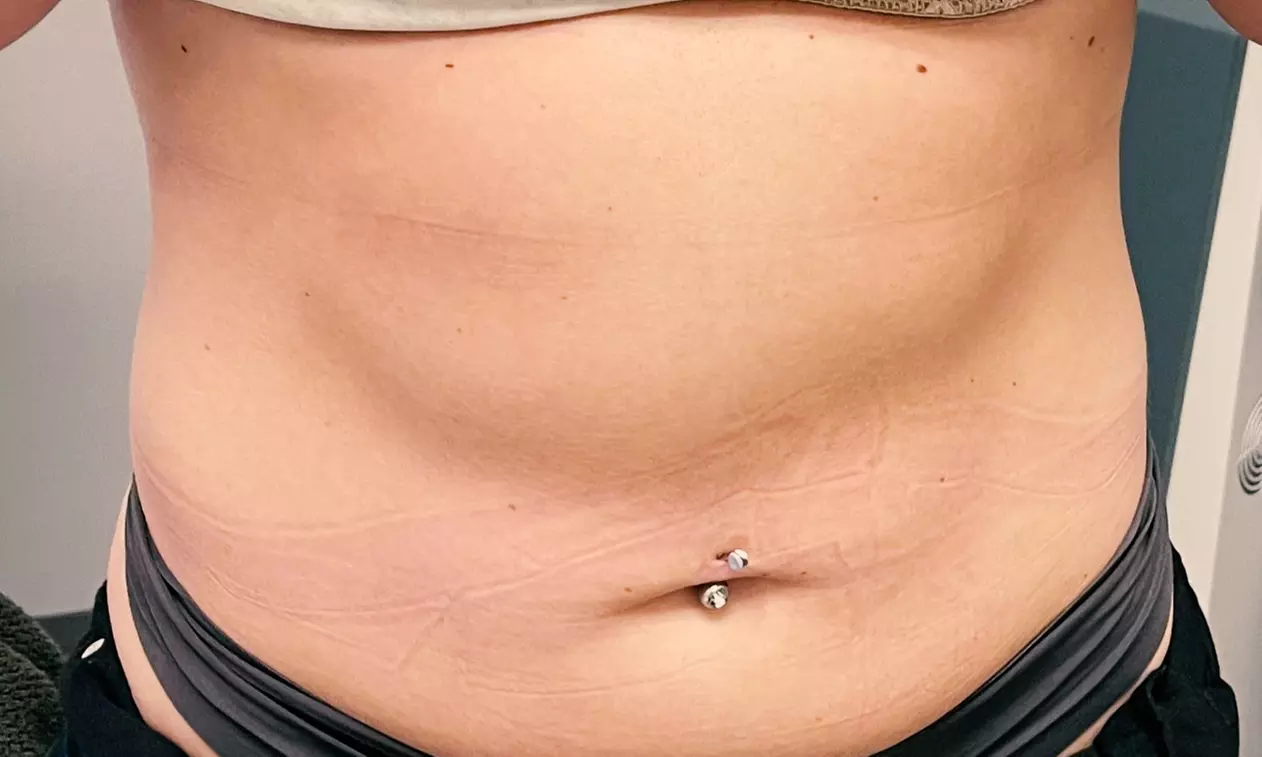 Transform Your Shape with Two or Four Non-Invasive Lipo Body Sculping (Up To 66% Off) - Second Medium