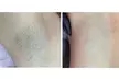 Depilacja laserowa wybranych partii lub całego ciała u kobiet i mężczyzn w PureEffect - Image 4