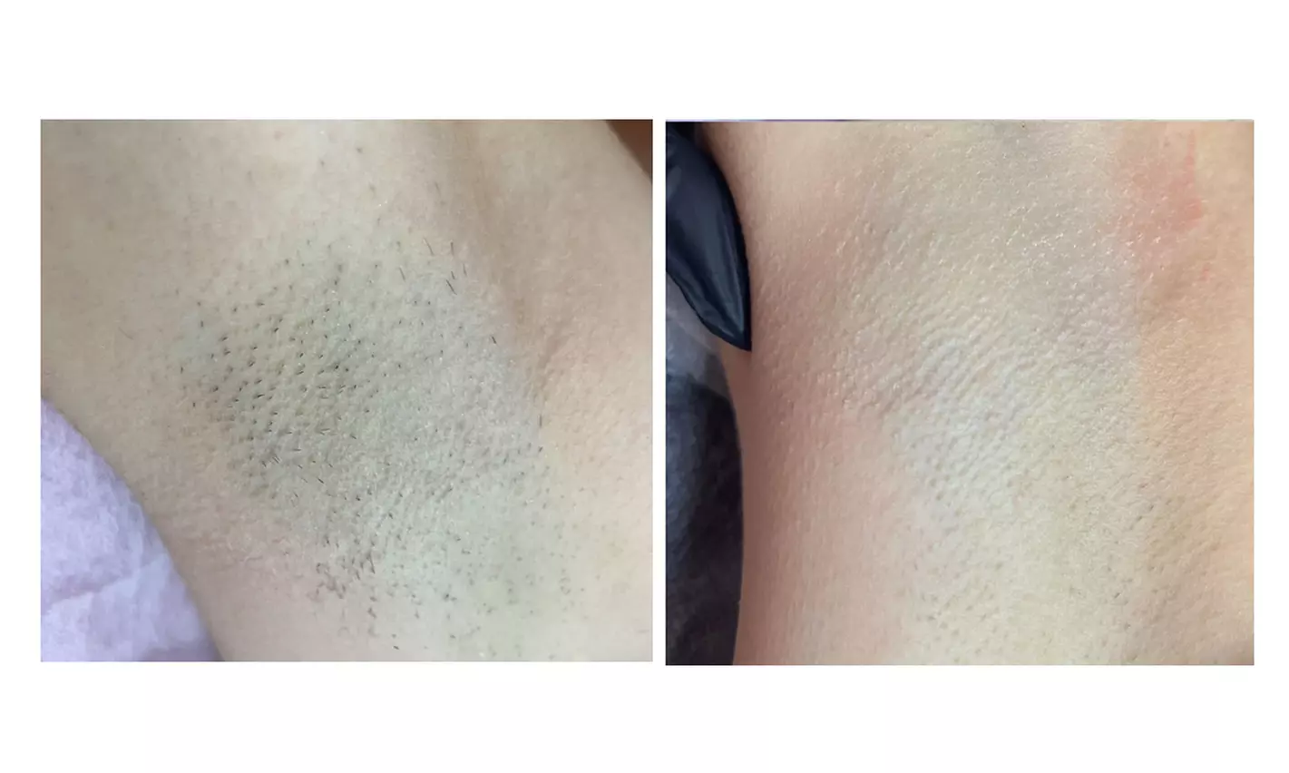 Depilacja laserowa wybranych partii lub całego ciała kobiet i mężczyzn