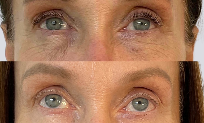 Image 2: Revitalize Skin with Rejuran I and Classic options