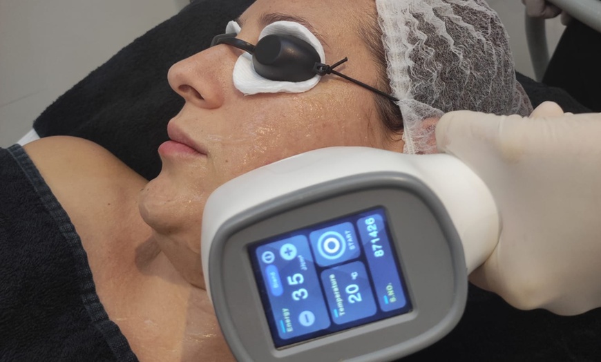 Image 7: Tratamiento facial con láser en Sapphira Prive Madrid centro