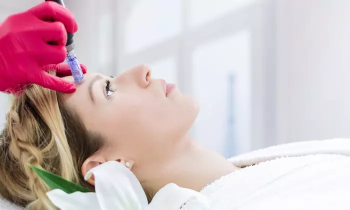 One or Three Microneedling Sessions at Luminous Medical Laser And  Electrolysis (Up to 27% Off) - Primary Image