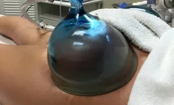 Quick & Effective Non-Surgical Butt Lift Options Available