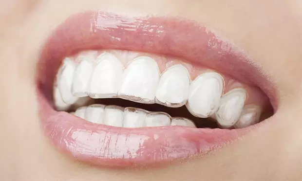 $1,000 Value Toward Invisalign Treatment at Dr. Dona M Seely (Up to 98% Off) - Primary Image