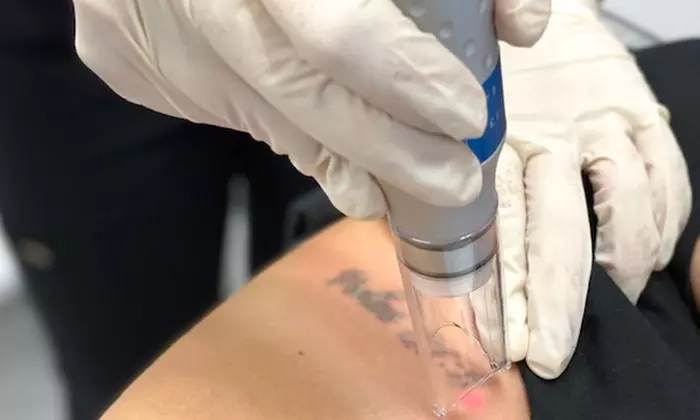 Tattoo Removal Sessions for Small, Medium, and Large Areas