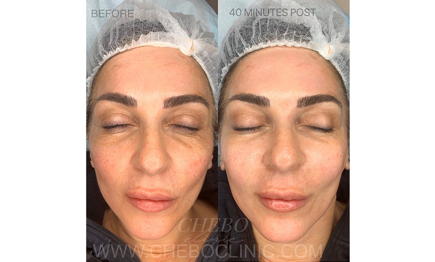 Image 2: 7D HIFU Brow Lift