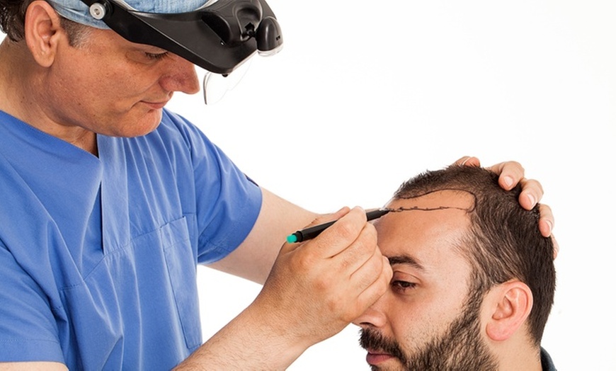 Image 1: Scalp Micropigmentation