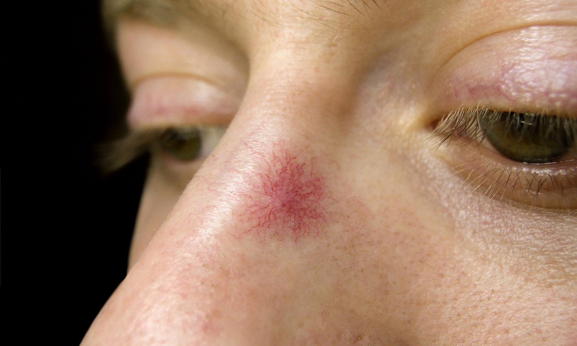 Laser Thread Vein Removal