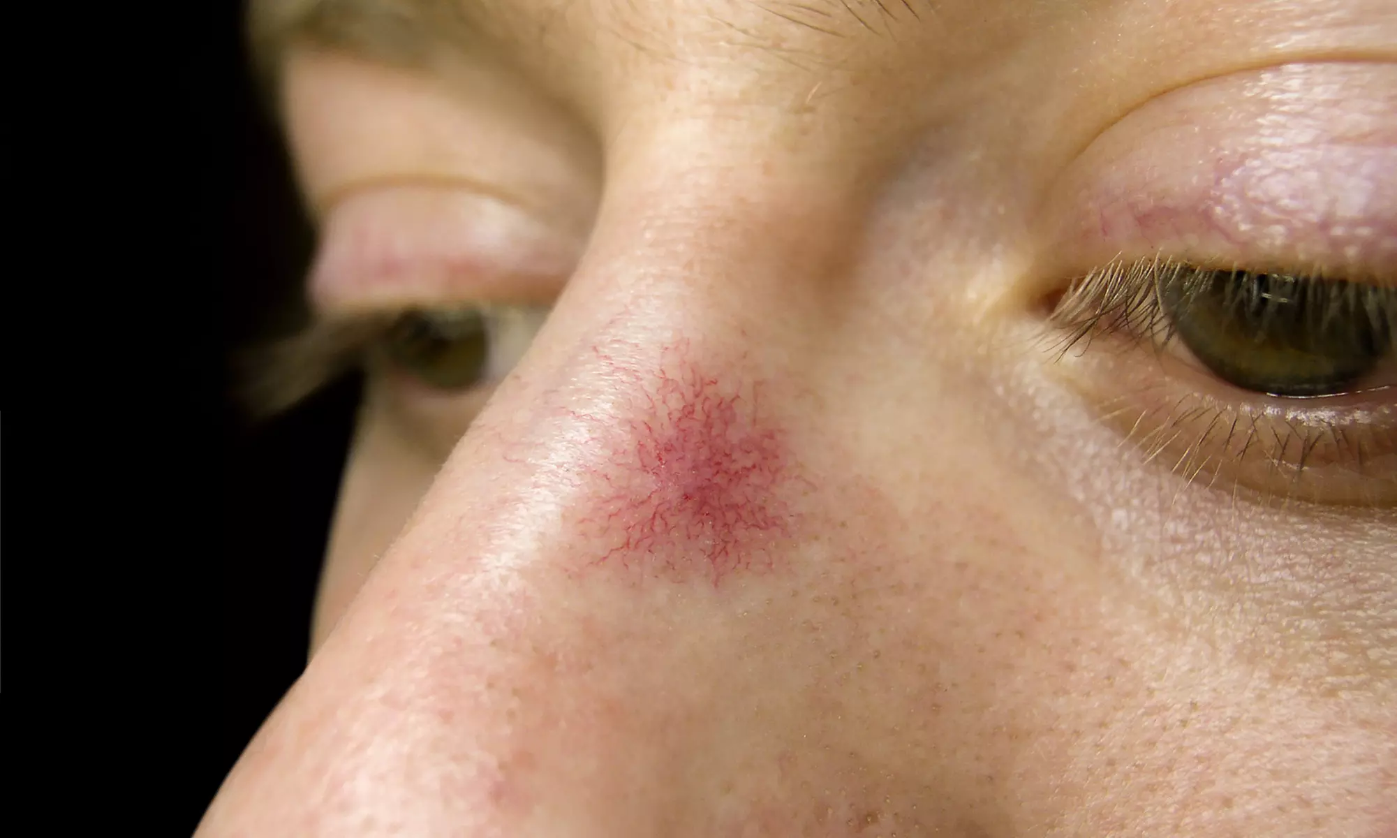 Laser Thread Vein Removal for Two or Four Areas at Laser Thread Vein Removal - Primary Image