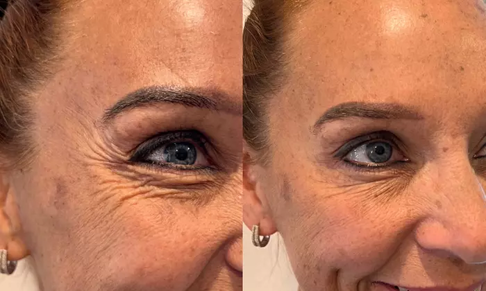 Experience Age Management Optimal Wellness's Jeuveau treatments with up to 32% off, offering 20 or 40 units for wrinkle reduction. - Second Medium