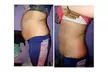 One, Two, or Three Fat Freezing Treatments with Complimentary Meal Plan at Liposuction Belfast (Up to 67% Off) - Image 7