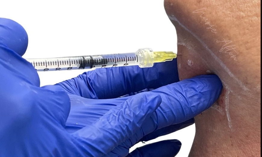 Image 5: ✨ Say Goodbye to the Double Chin with Kybella® ✨