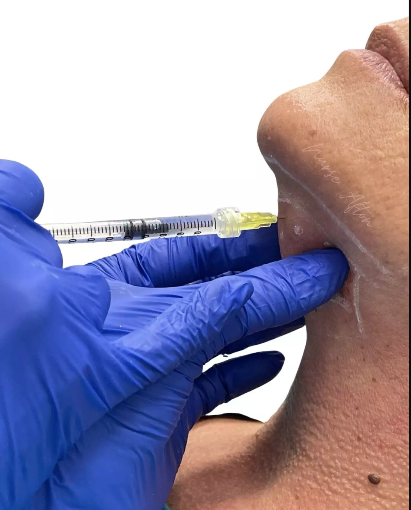 ✨ Say Goodbye to the Double Chin with Kybella® ✨