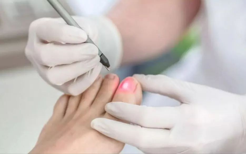 Eliminación de hongos de las uñas en HundredFeet - Clínica TEN