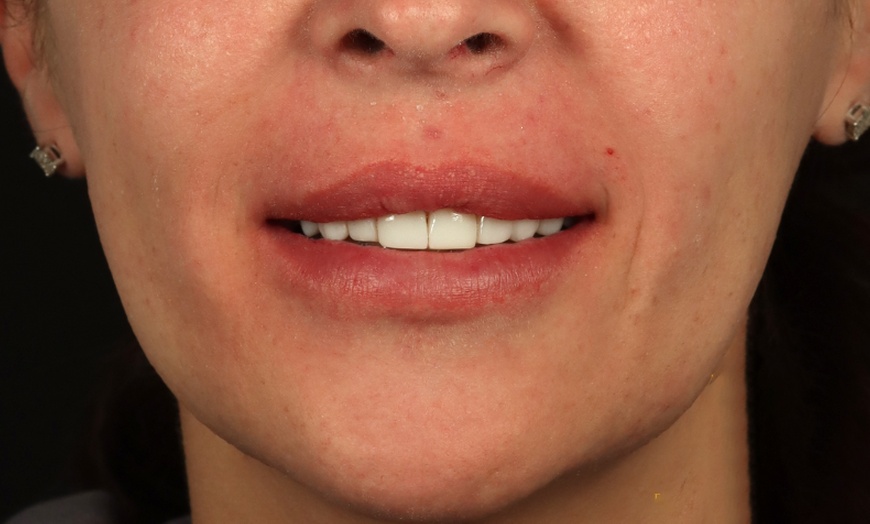 Image 2: Composite Bonding with Whitening at Poynton Dental Practice