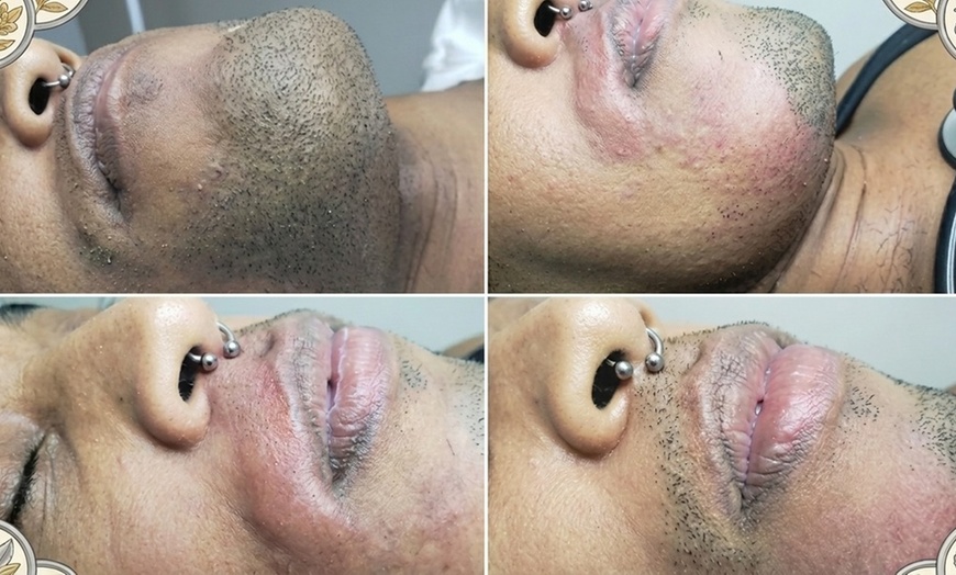 Image 3: Long-Lasting Electrolysis Hair Removal Sessions