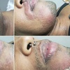 Image 3: Long-Lasting Electrolysis Hair Removal Sessions