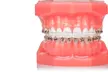 Estetyczny aparat ortodontyczny – komfort i skuteczność w jednym w Dental-Med - Second Medium