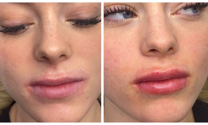 Image 5: 1ml or 2ml Filler for Lips, Russian Lips, Jawline, Chin or Cheek 