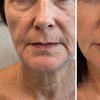 Image 3: Skin-Rejuvenating Fractional CO2 Laser Treatment for Wrinkles & Scars