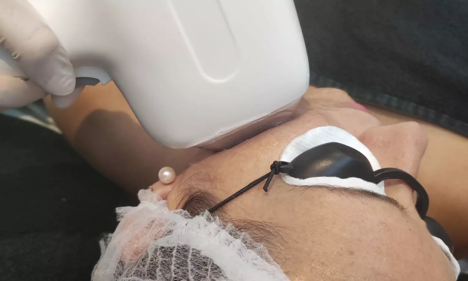 Tratamiento facial con láser en Sapphira Prive Madrid centro