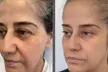 Transform with 1 or 3 Morpheus 8 RF Contouring Treatments at Dr. V's NY Med Spa - Up to 50% Off - Second Medium