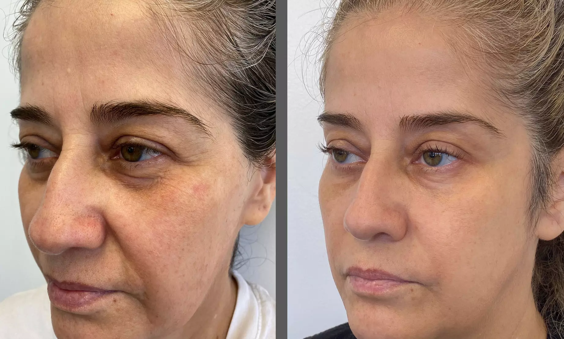 Transform with 1 or 3 Morpheus 8 RF Contouring Treatments