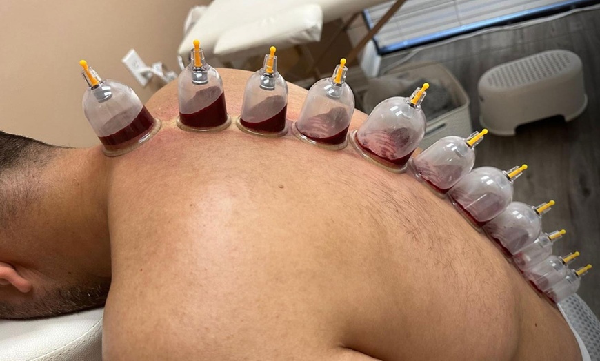 Image 4: 20-Minute 1, 3, or 5 Combination Cupping Sessions: (Wet, Dry & Moving)