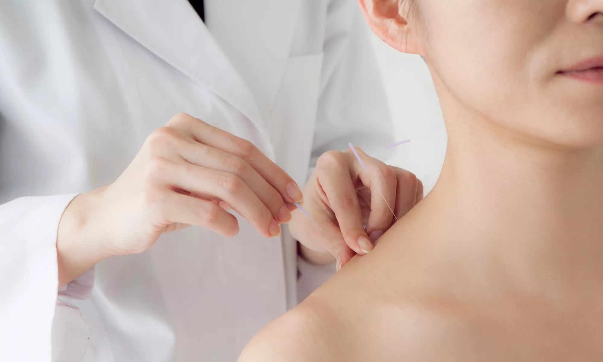 45-Minute Acupuncture Session