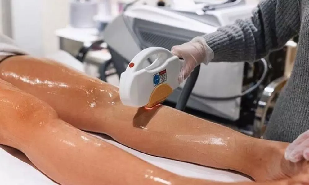 Verlies vet door het te laten bevriezen: cryolipolyse behandeling