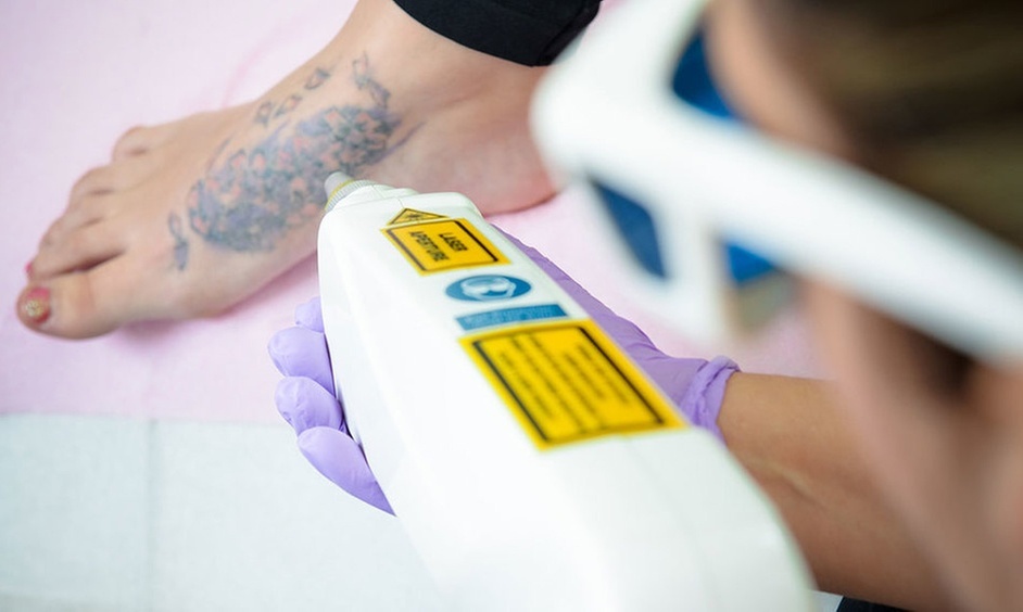 Laser Tattoo Removal