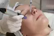 Awaken Your Skin’s Natural Power: PRP Facial + Microneedling at Renova Med Spa - Second Medium
