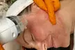 Reveal Radiant Skin with Expert Microneedling & PRP Facials in Upper Darby – Up to 70% Off - Second Medium