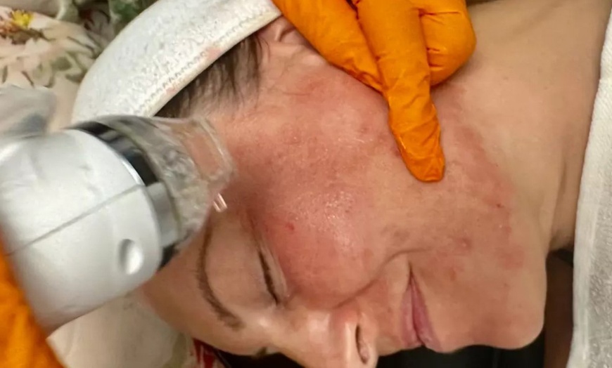 Image 4: Radiant Skin with Expert Microneedling & PRP Facials in Upper Darby


