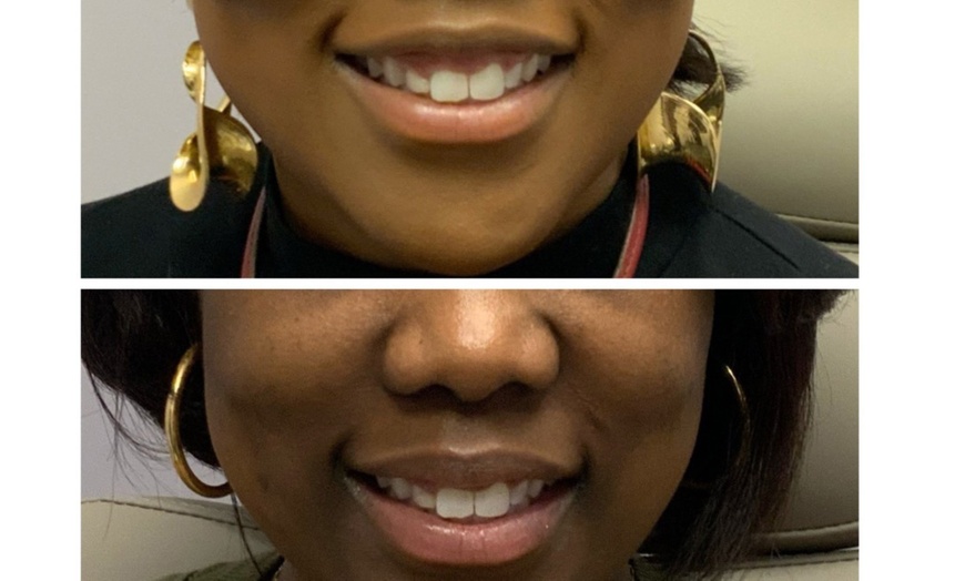 Image 10: Refresh Your Look with 10, 20, or 30 Units of Xeomin/Jeuveau