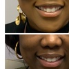 Image 10: Refresh Your Look with 10, 20, or 30 Units of Xeomin/Jeuveau